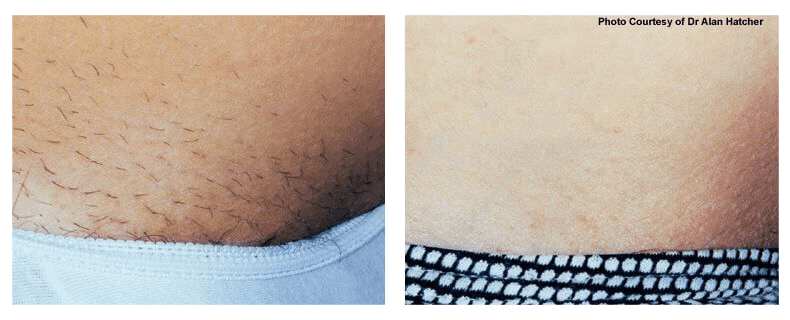 Laser Hair Removal Laser Skin Treatments in Gulfport MS