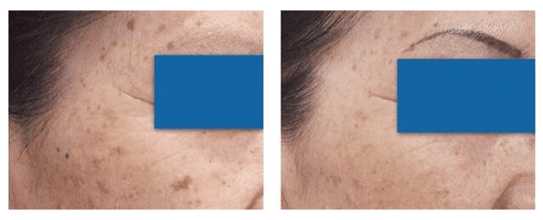 Laser Hair Removal Laser Skin Treatments in Gulfport MS