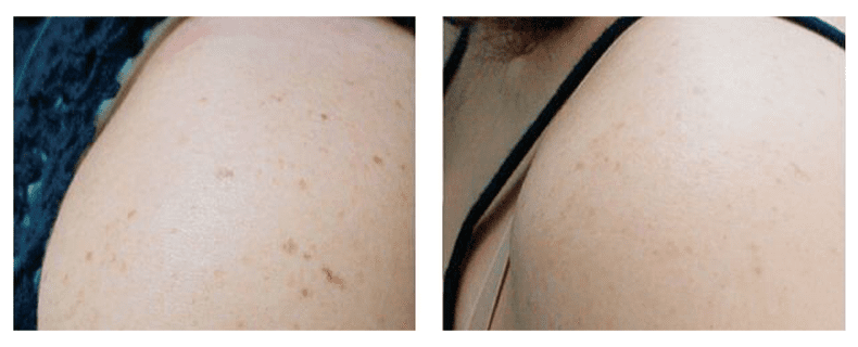 Laser Hair Removal Laser Skin Treatments in Gulfport MS